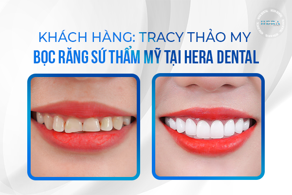 Tình trạng trước và sau khi bọc toàn sứ của Tracy Thảo My